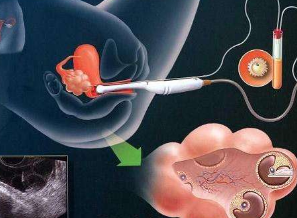 六安捐卵机构公司